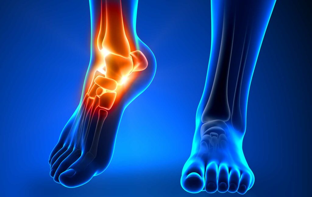 Welke schoenen na enkelbreuk