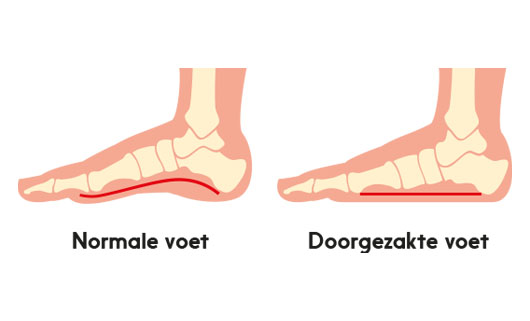 Welke schoenen bij een doorgezakte voet? - Allesoverschoenen.nl